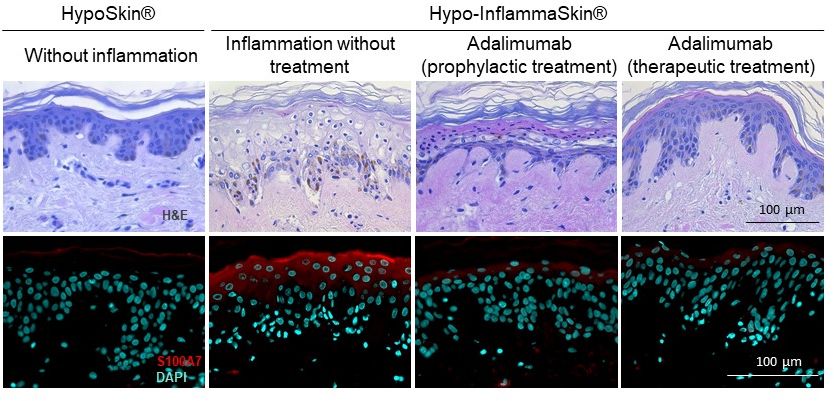 psoriasis biologics histology adalimumab