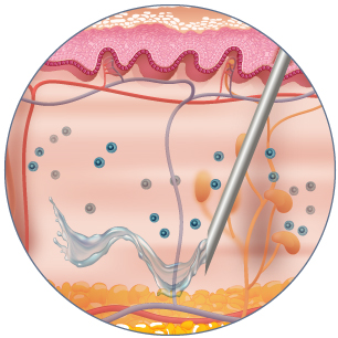 in situ mast cells degranulation