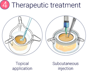 A serie of 4 illustrations showing the production of InflammaSkin® model from resident T cell in situ activation to the therapeutic treatment